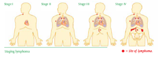 How long does stage 4 lymphoma last