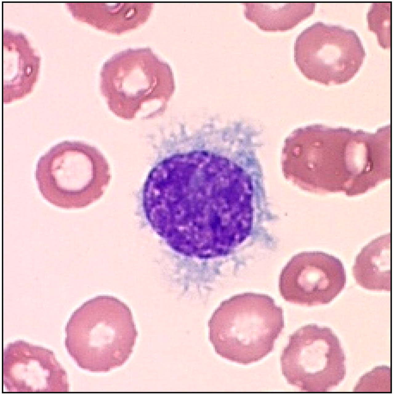 10 Symptoms of hairy cell leukemia You Should Never Ignore